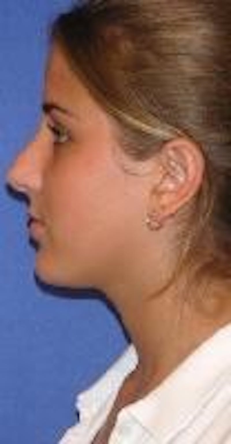 Rhinoplasty Before & After Gallery - Patient 91459477 - Image 2