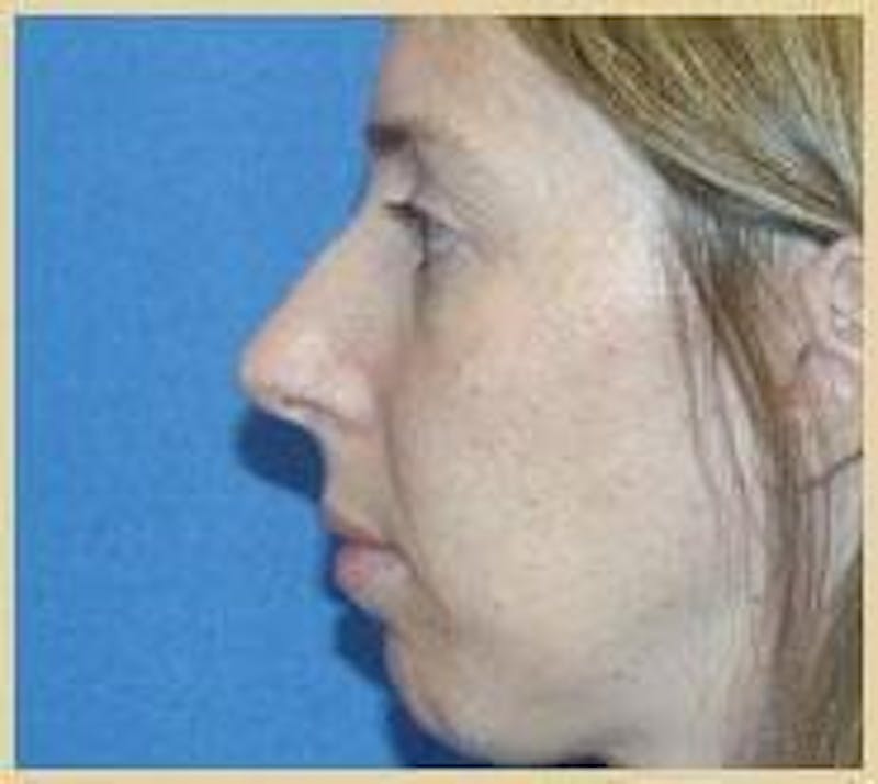 Rhinoplasty Before & After Gallery - Patient 91459481 - Image 1