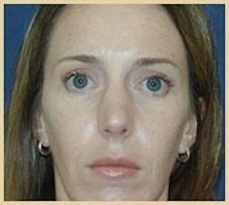 Rhinoplasty Before & After Gallery - Patient 91459481 - Image 6