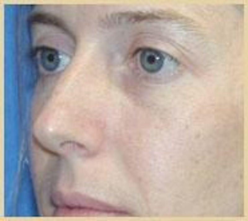 Rhinoplasty Before & After Gallery - Patient 91459481 - Image 3