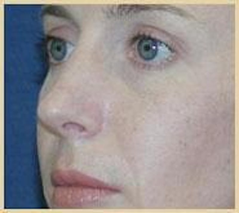Rhinoplasty Before & After Gallery - Patient 91459481 - Image 4