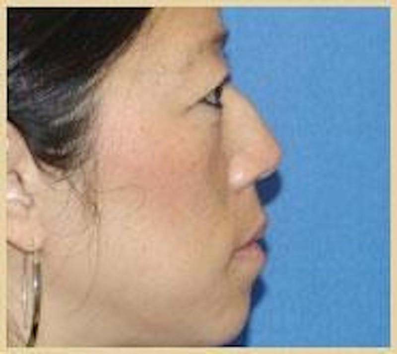 Rhinoplasty Before & After Gallery - Patient 91459483 - Image 1