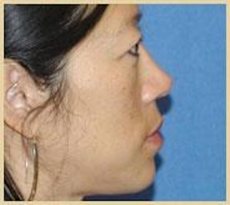 Rhinoplasty Before & After Gallery - Patient 91459483 - Image 2