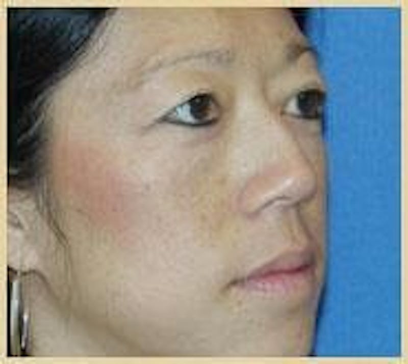 Rhinoplasty Before & After Gallery - Patient 91459483 - Image 3
