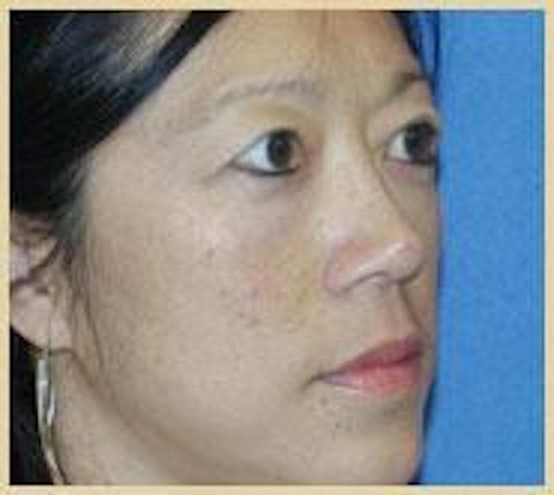Rhinoplasty Before & After Gallery - Patient 91459483 - Image 4