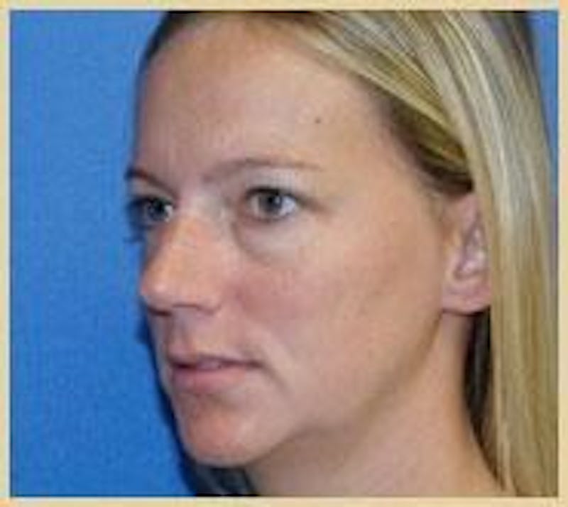 Rhinoplasty Before & After Gallery - Patient 91459484 - Image 3