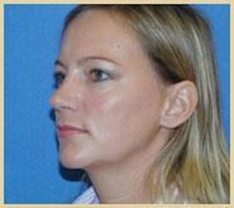 Rhinoplasty Before & After Gallery - Patient 91459484 - Image 4
