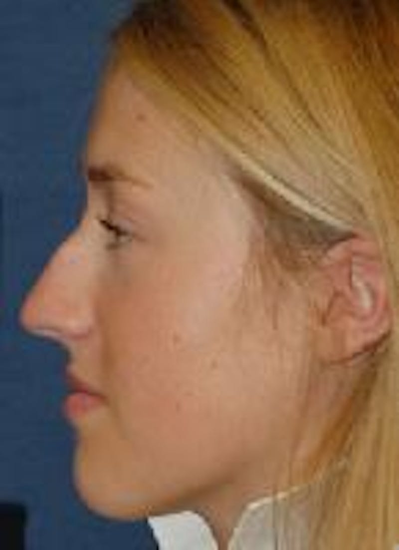 Rhinoplasty Before & After Gallery - Patient 91459486 - Image 1