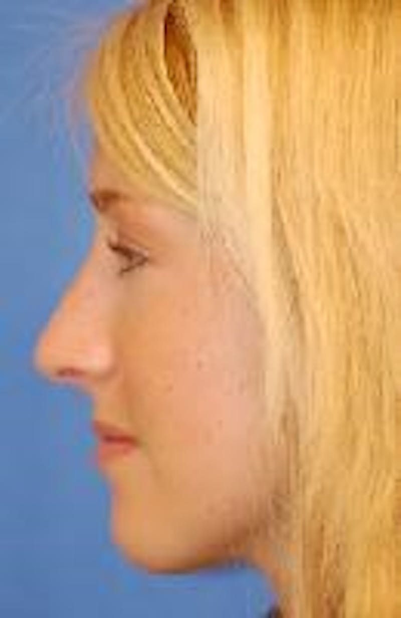 Rhinoplasty Before & After Gallery - Patient 91459486 - Image 2