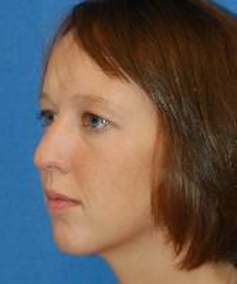 Rhinoplasty Before & After Gallery - Patient 91459487 - Image 3