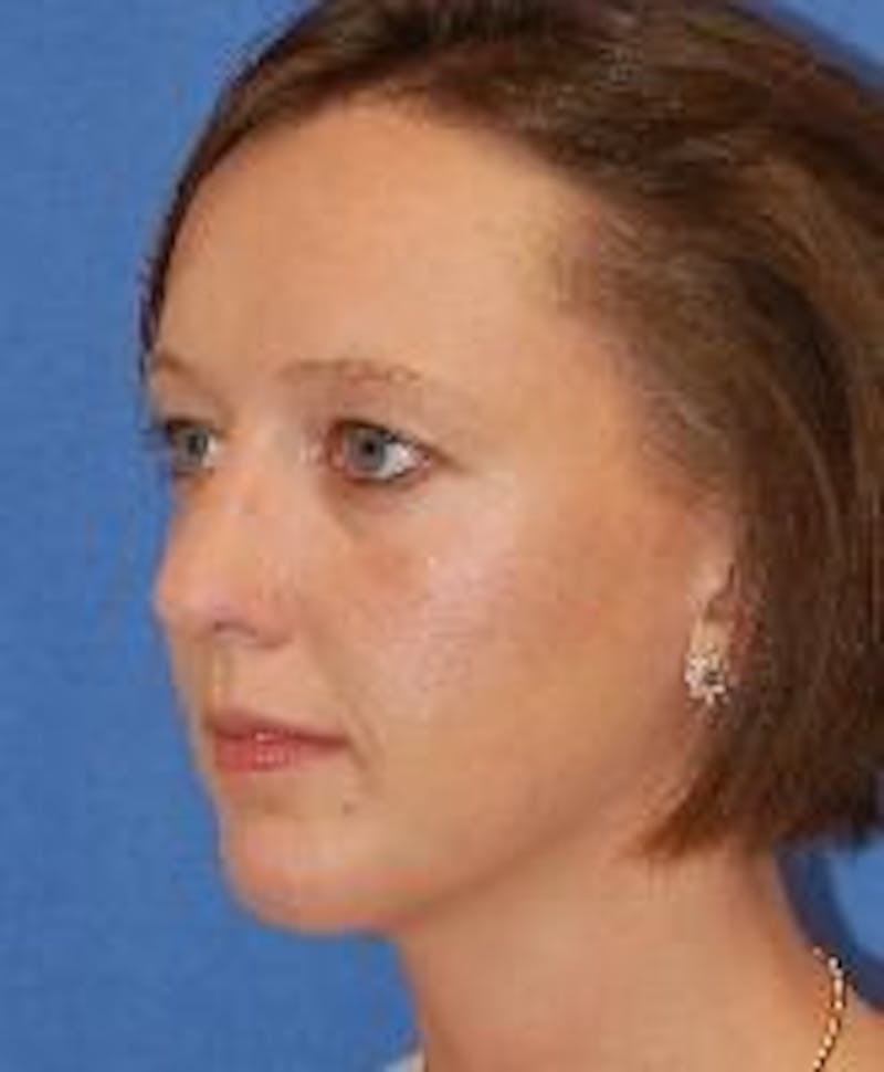 Rhinoplasty Before & After Gallery - Patient 91459487 - Image 4