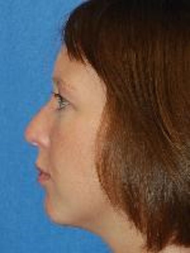 Rhinoplasty Before & After Gallery - Patient 91459487 - Image 1