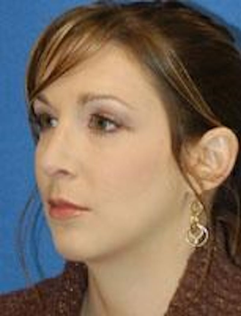 Rhinoplasty Before & After Gallery - Patient 91459488 - Image 4
