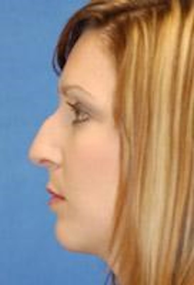 Rhinoplasty Before & After Gallery - Patient 91459488 - Image 1