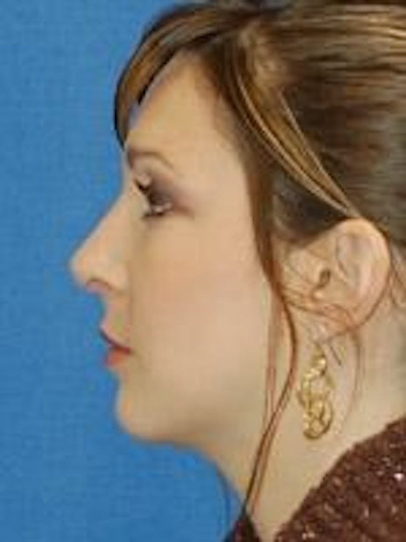 Rhinoplasty Before & After Gallery - Patient 91459488 - Image 2