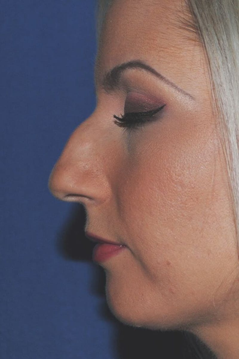 Rhinoplasty Before & After Gallery - Patient 91459490 - Image 1