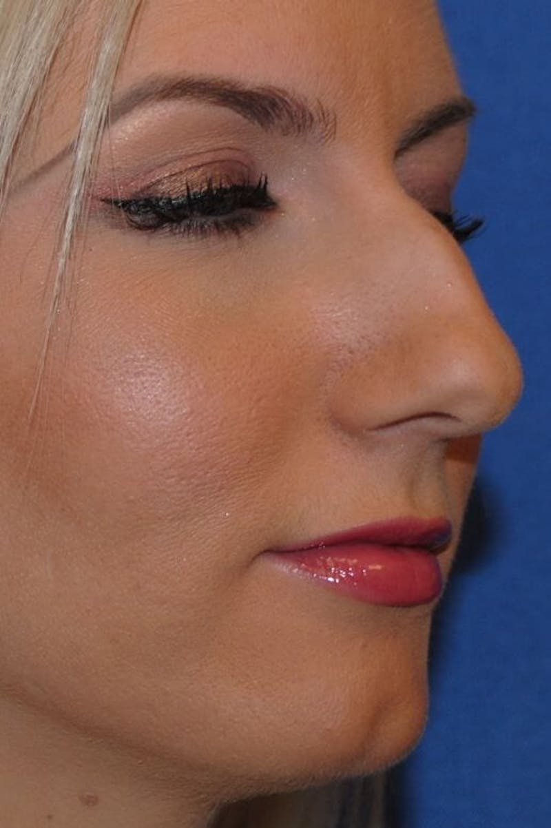 Rhinoplasty Before & After Gallery - Patient 91459490 - Image 3