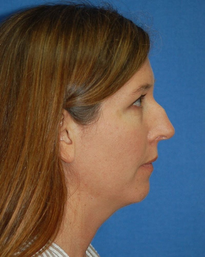 Rhinoplasty Before & After Gallery - Patient 91459492 - Image 1