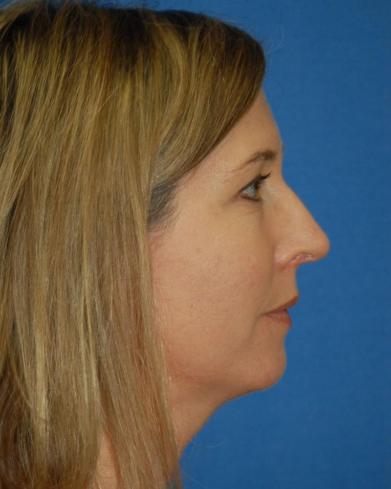 Rhinoplasty Before & After Gallery - Patient 91459492 - Image 2