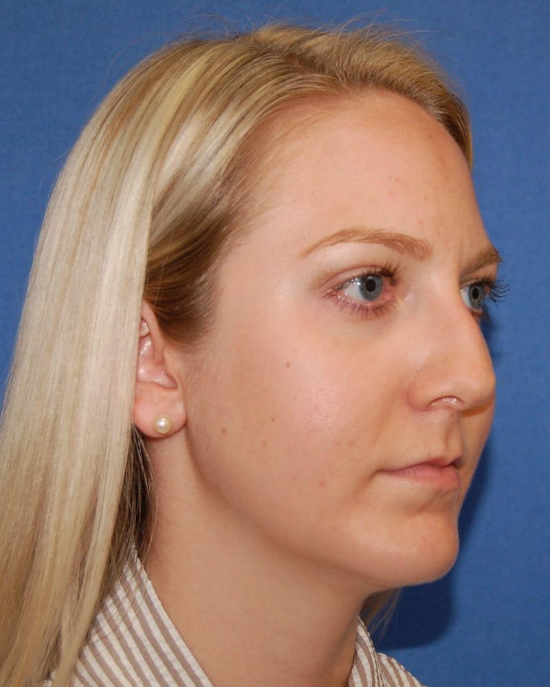 Rhinoplasty Before & After Gallery - Patient 91459494 - Image 1