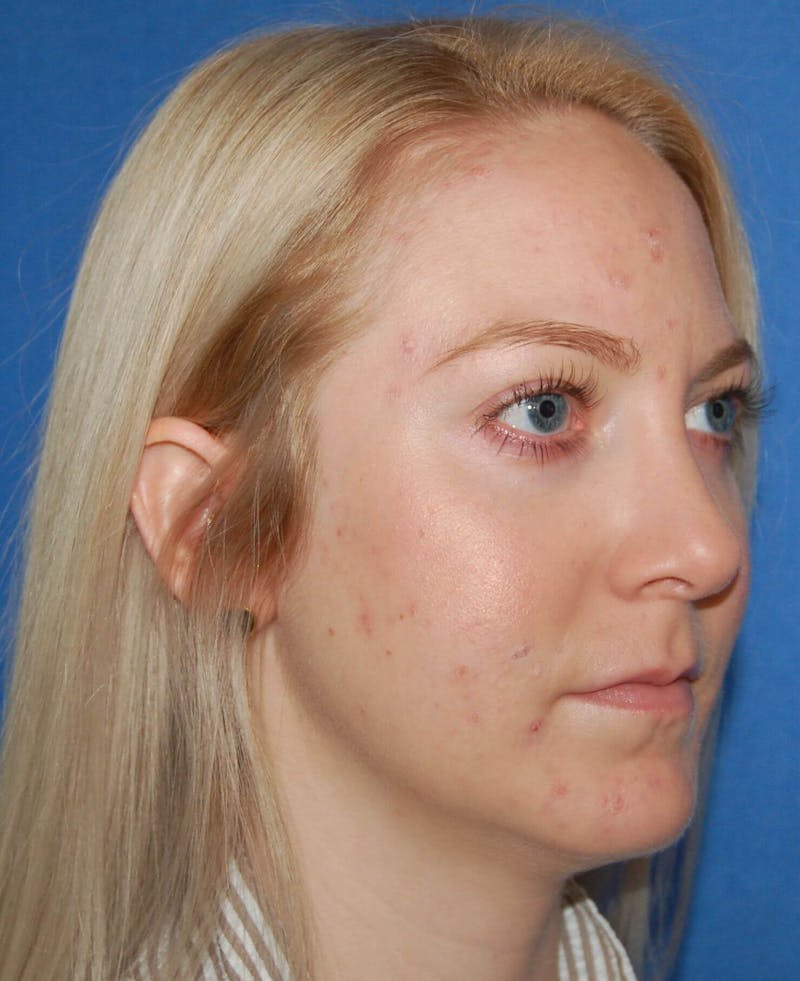 Rhinoplasty Before & After Gallery - Patient 91459494 - Image 2