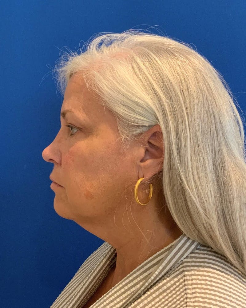 Neck Lift Before & After Gallery - Patient 91474153 - Image 5