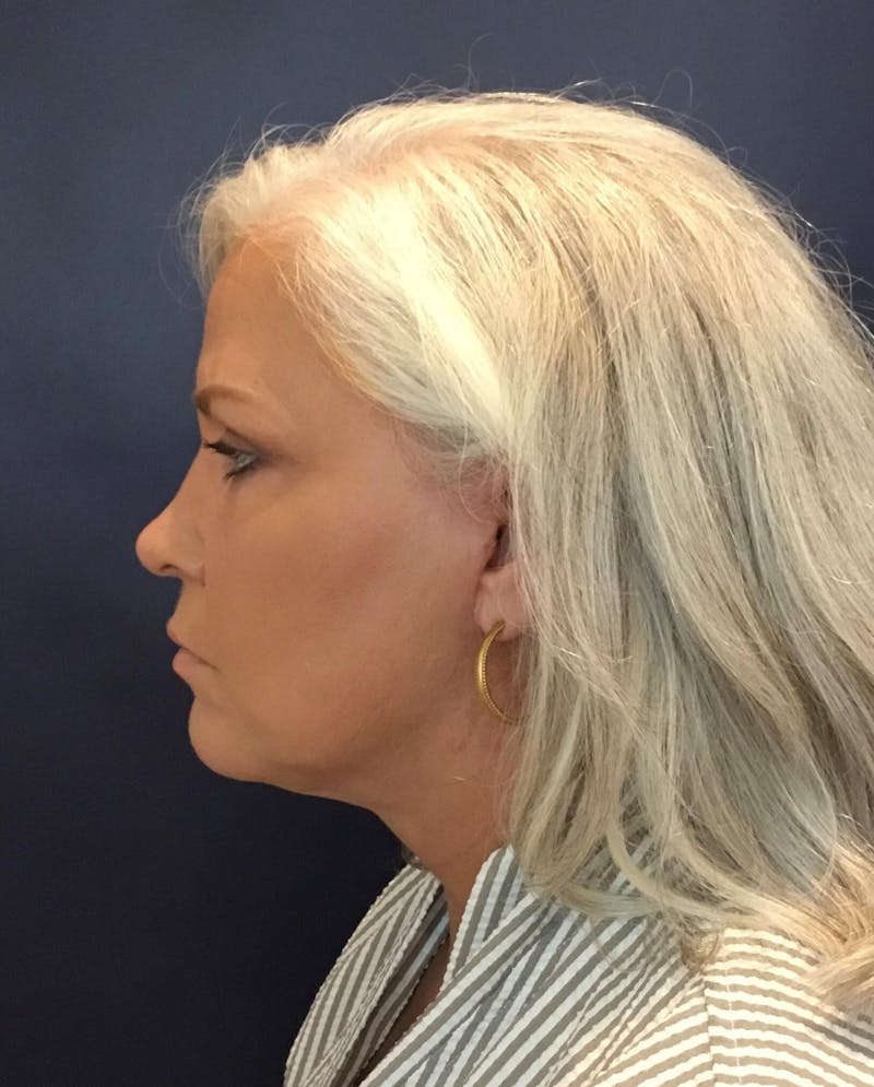 Neck Lift Before & After Gallery - Patient 91474153 - Image 6