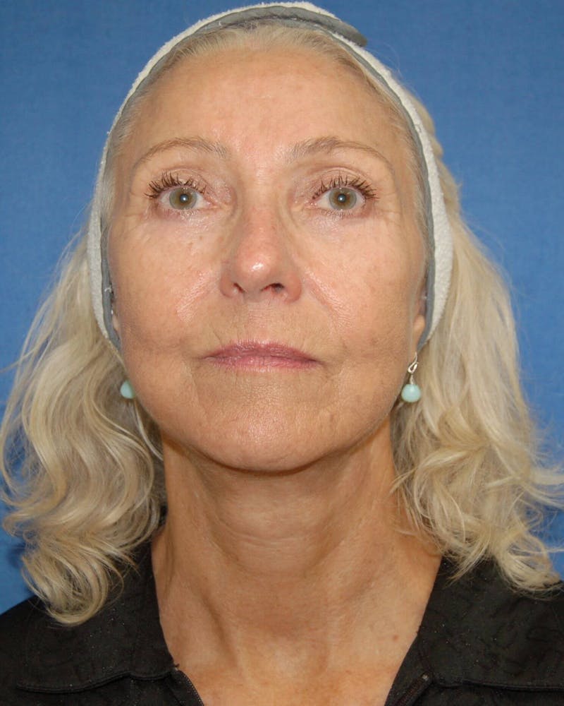 Neck Lift Before & After Gallery - Patient 91474154 - Image 2