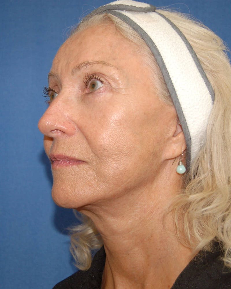 Neck Lift Before & After Gallery - Patient 91474154 - Image 4