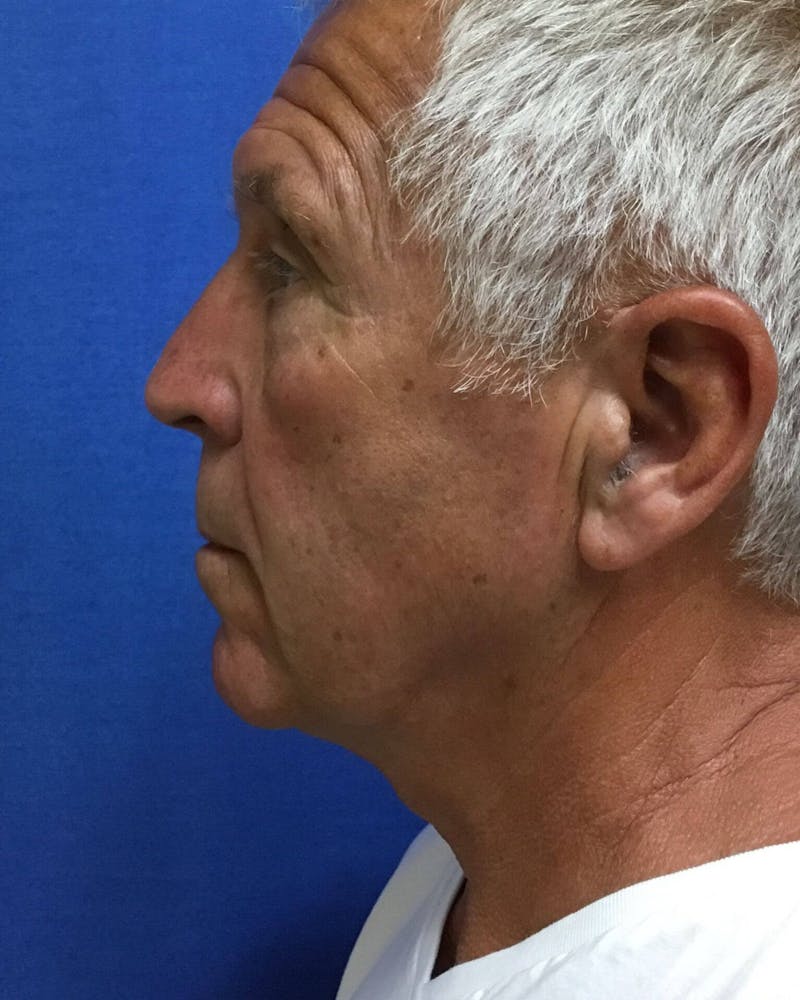 Neck Lift Before & After Gallery - Patient 91474156 - Image 4