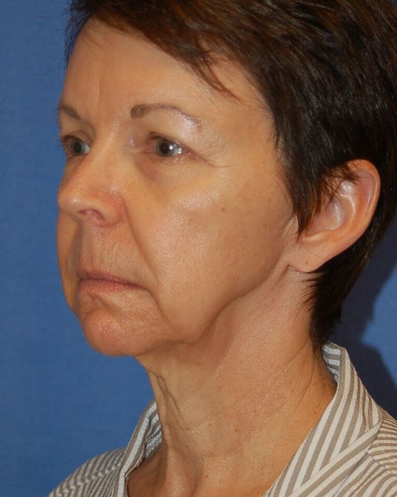 Neck Lift Before & After Gallery - Patient 91474157 - Image 3