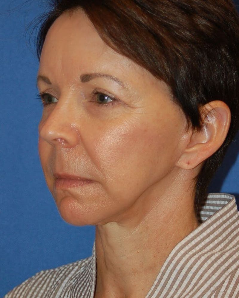 Neck Lift Before & After Gallery - Patient 91474157 - Image 4