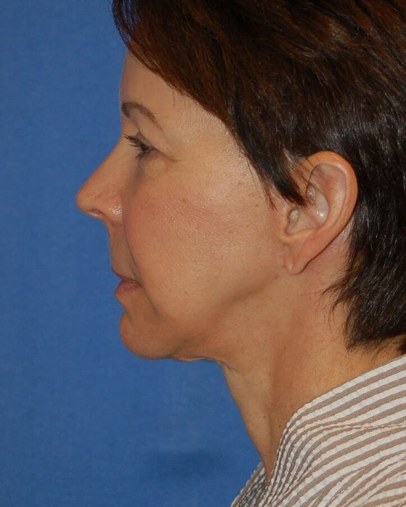 Neck Lift Before & After Gallery - Patient 91474157 - Image 6
