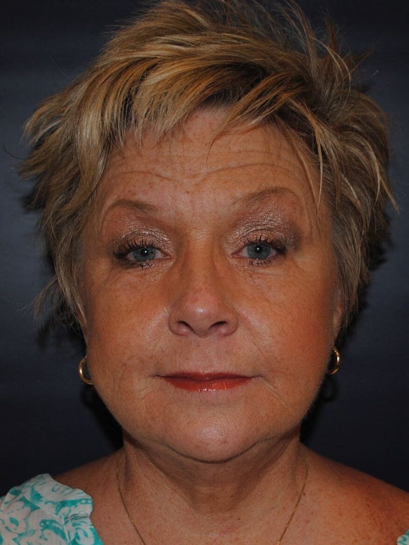 Neck Lift Before & After Gallery - Patient 91474167 - Image 2