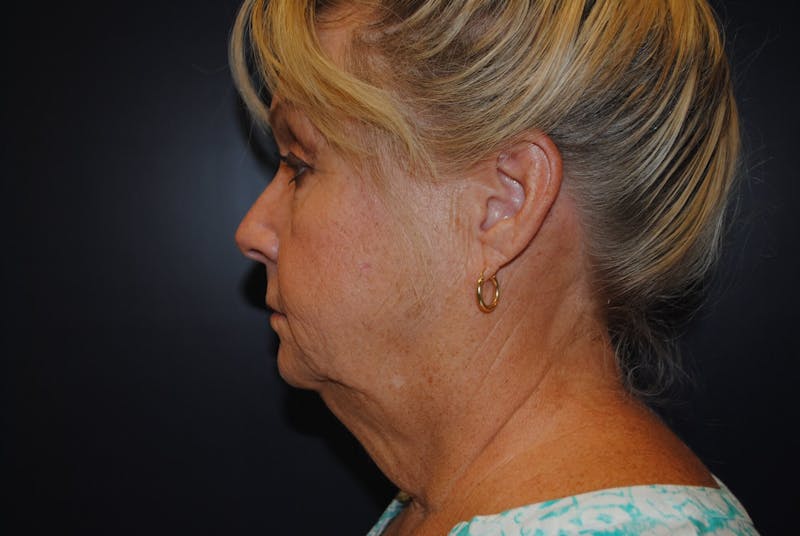 Neck Lift Before & After Gallery - Patient 91474167 - Image 3