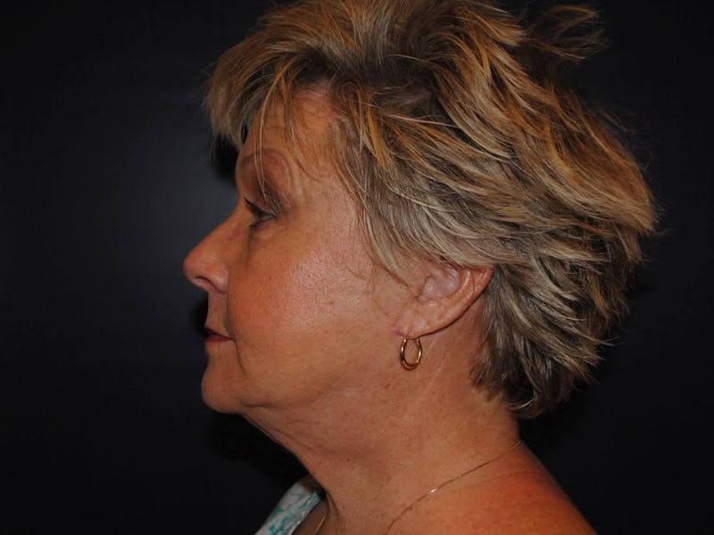 Neck Lift Before & After Gallery - Patient 91474167 - Image 4