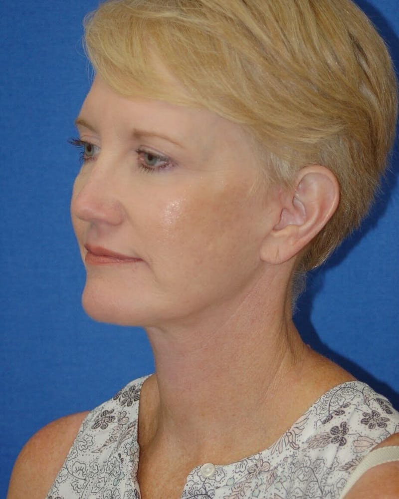 Neck Lift Before & After Gallery - Patient 91474226 - Image 4