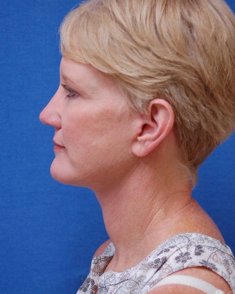 Neck Lift Before & After Gallery - Patient 91474226 - Image 6