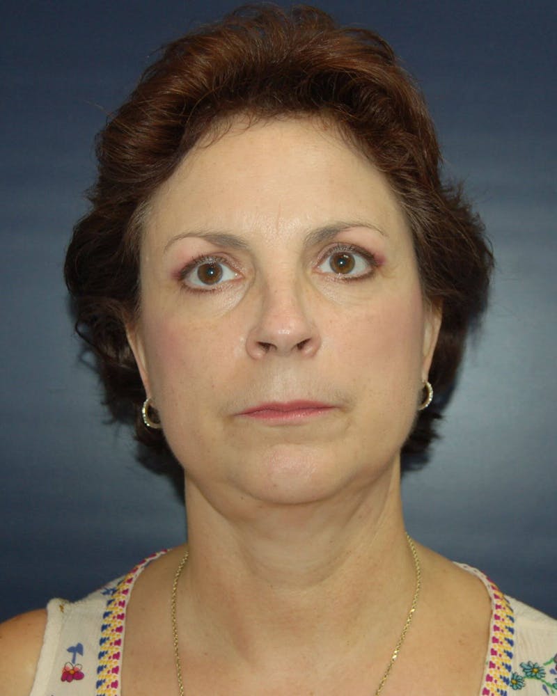 Neck Lift Before & After Gallery - Patient 91474230 - Image 2
