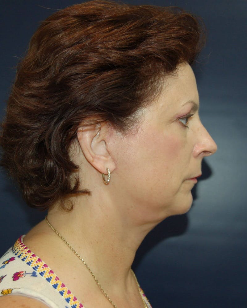 Neck Lift Before & After Gallery - Patient 91474230 - Image 4
