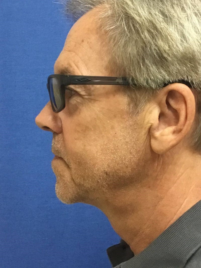 Neck Lift Before & After Gallery - Patient 91474231 - Image 4