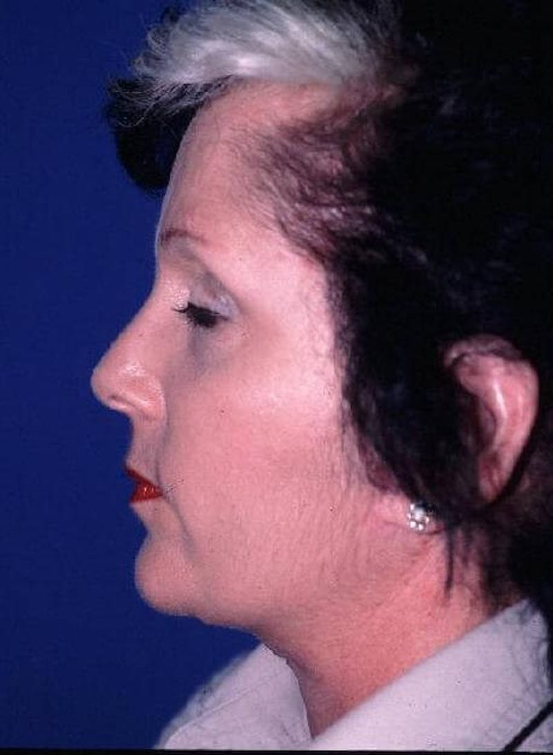 Neck Lift Before & After Gallery - Patient 91474234 - Image 4