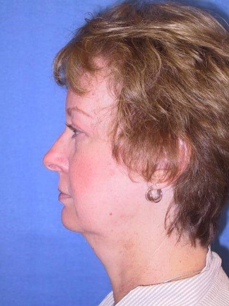 Neck Lift Before & After Gallery - Patient 91474236 - Image 5
