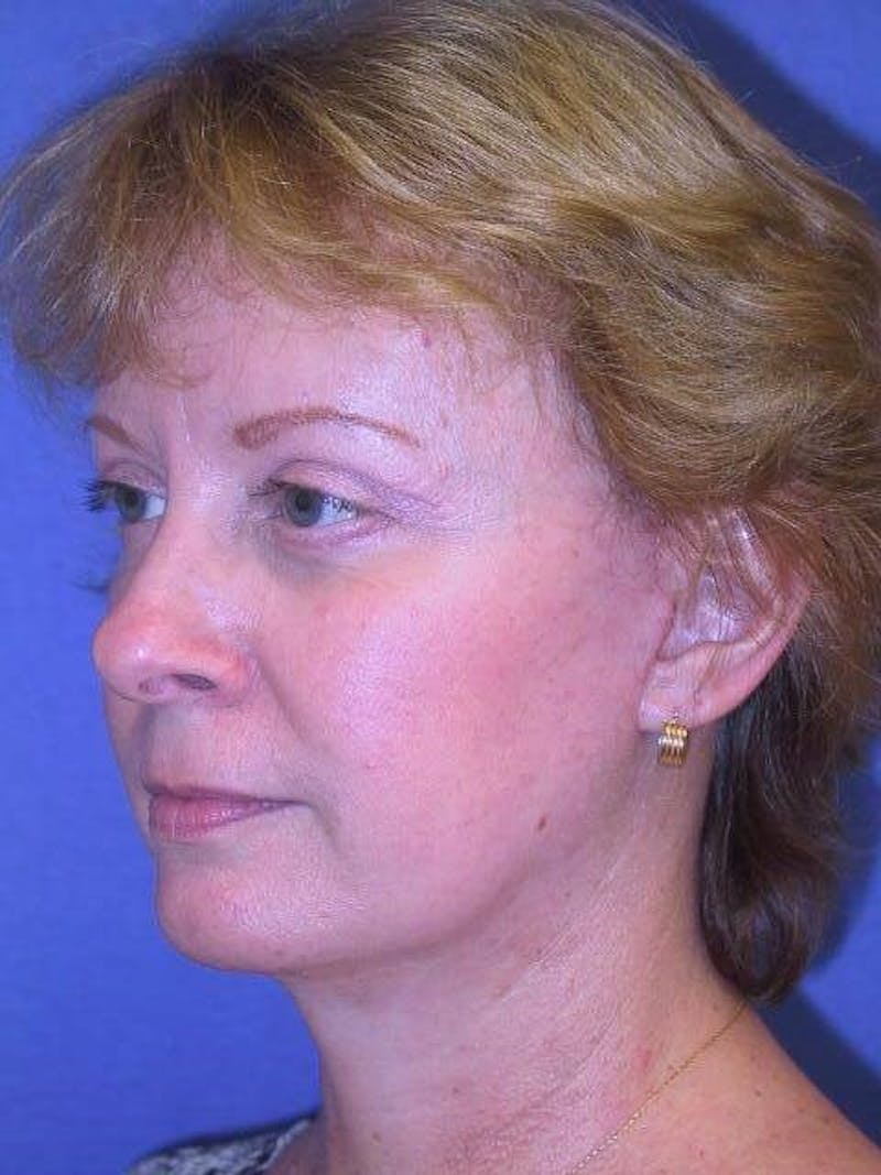 Neck Lift Before & After Gallery - Patient 91474236 - Image 4