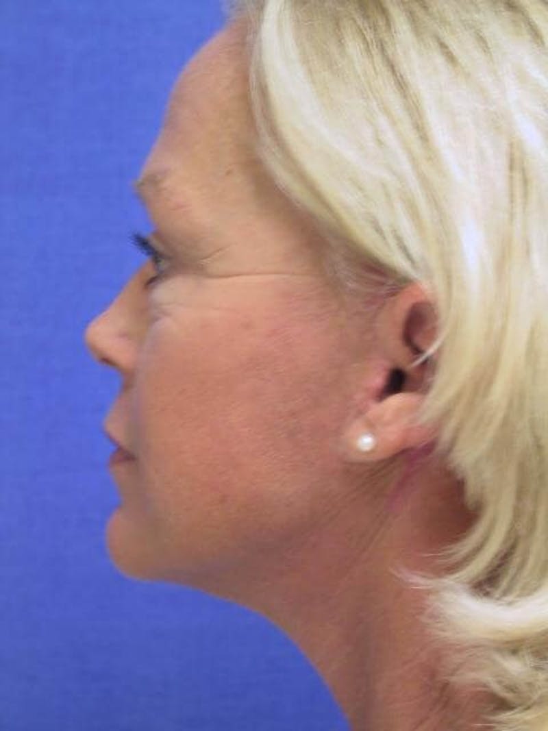 Neck Lift Before & After Gallery - Patient 91474241 - Image 6