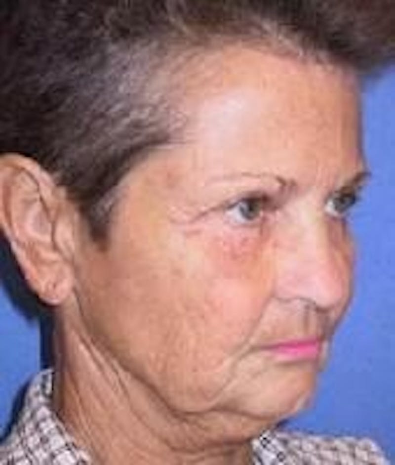 Neck Lift Before & After Gallery - Patient 91474244 - Image 3