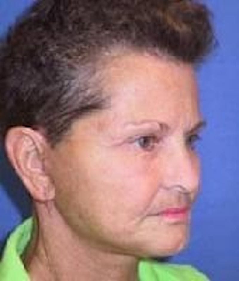 Neck Lift Before & After Gallery - Patient 91474244 - Image 2