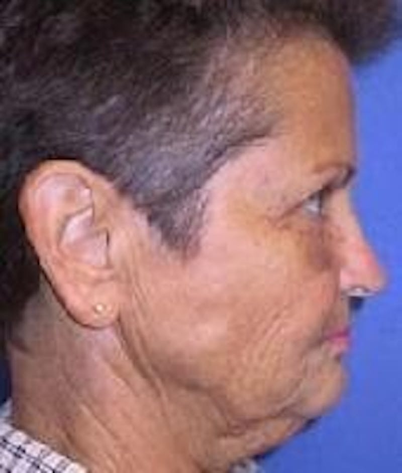 Neck Lift Before & After Gallery - Patient 91474244 - Image 5