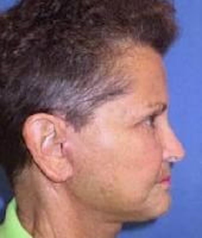 Neck Lift Before & After Gallery - Patient 91474244 - Image 6