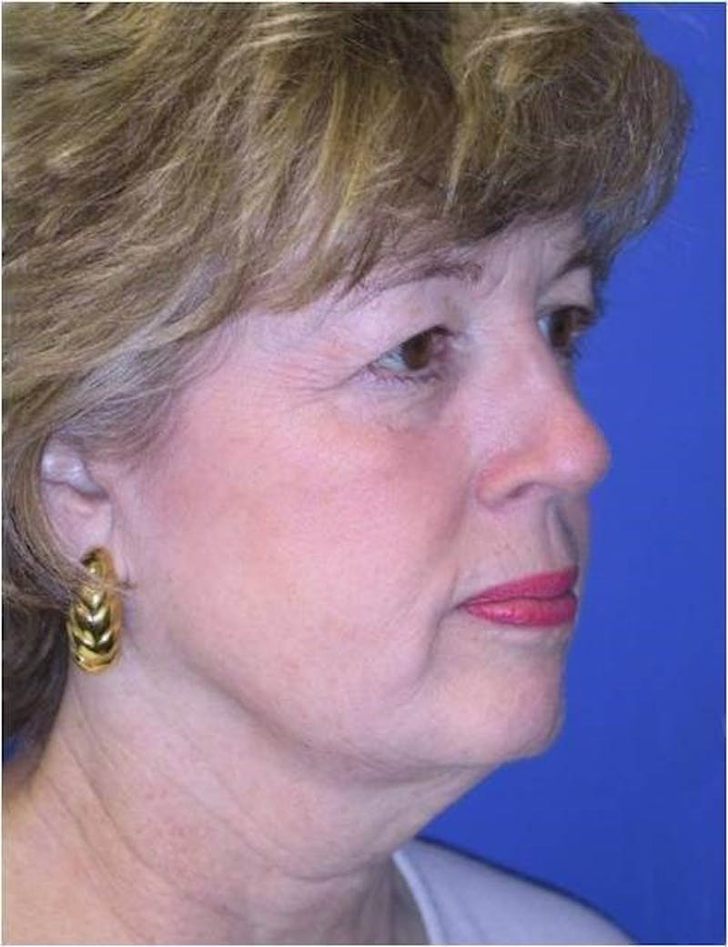Neck Lift Before & After Gallery - Patient 91474246 - Image 3